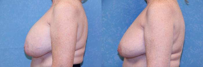Before & After Implant Revision Case 603 Left Side View in Toledo, Ohio