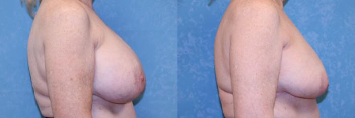 Before & After Implant Revision Case 603 Right Side View in Toledo, Ohio