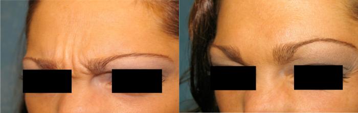 Before & After Injectable Treatments Case 114 View #1 View in Toledo, Ohio