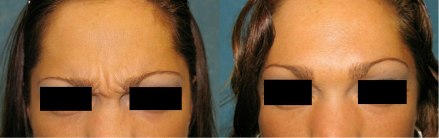 Before & After Injectable Treatments Case 114 View #2 View in Toledo, Ohio