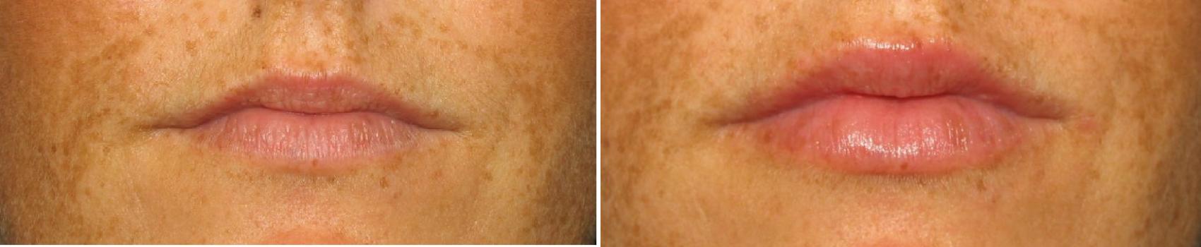 Before & After Injectable Treatments Case 122 View #1 View in Toledo, Ohio