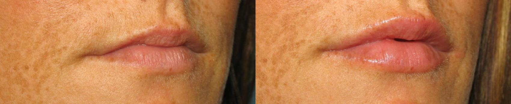 Before & After Injectable Treatments Case 122 View #2 View in Toledo, Ohio