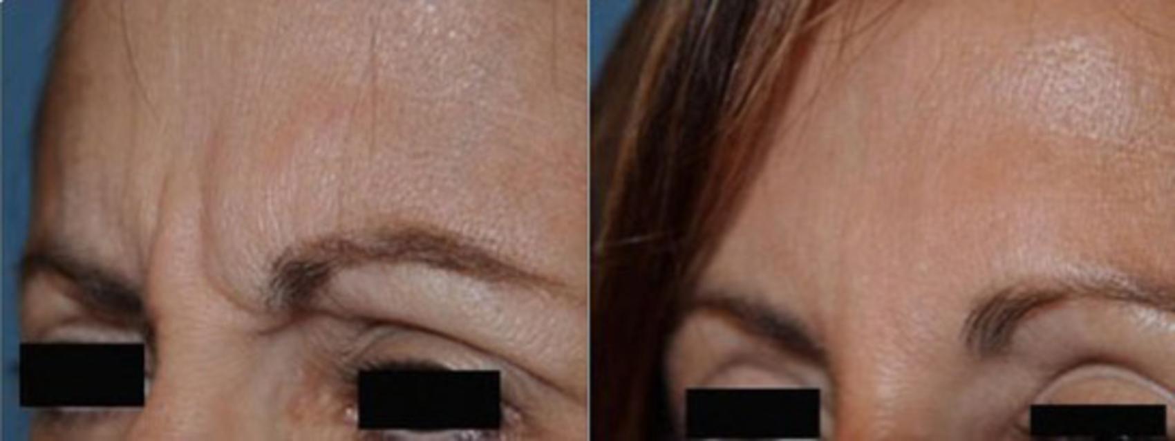 Before & After Injectable Treatments Case 17 View #1 View in Toledo, Ohio