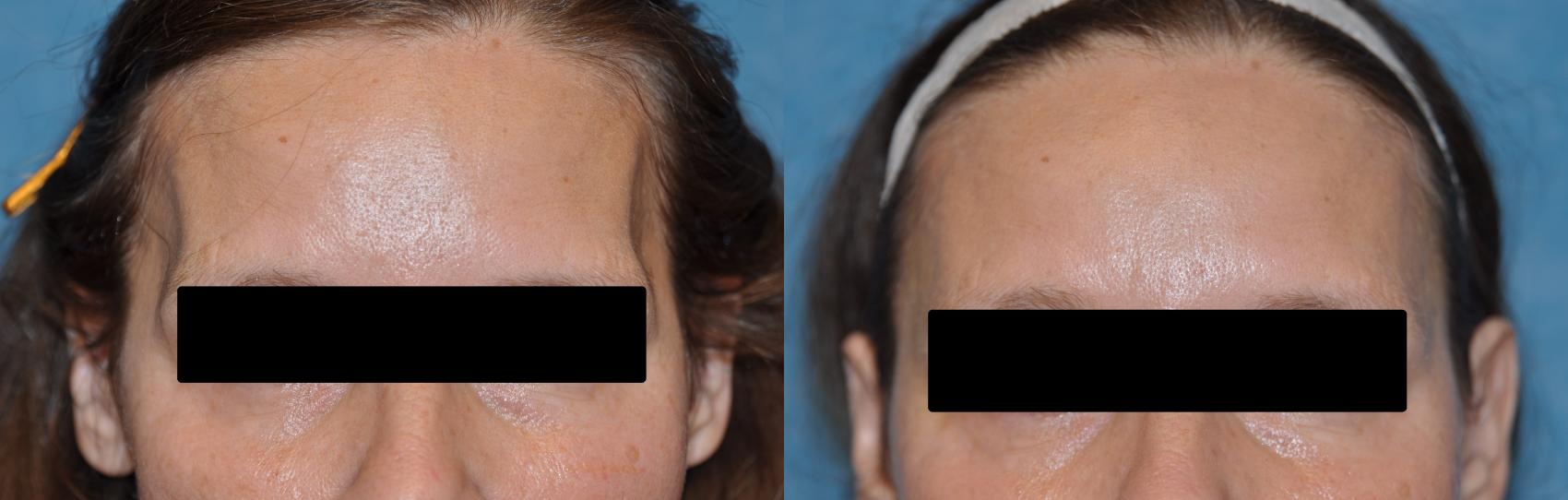 Before & After Injectable Treatments Case 223 View #1 View in Toledo, Ohio