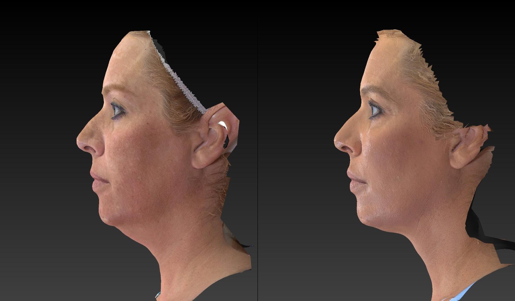 Before & After Injectable Treatments 3D Imaging Case 203 View #1 View in Toledo, Ohio