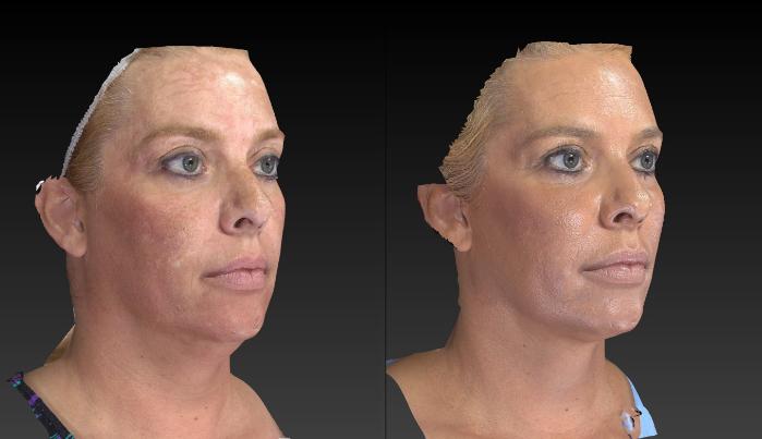 Before & After Injectable Treatments 3D Imaging Case 203 View #2 View in Toledo, Ohio