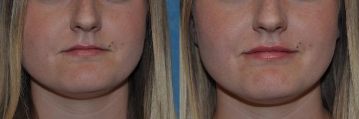 Before & After Injectable Treatments Case 406 Front View in Toledo, Ohio
