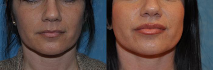 Before & After Injectable Treatments Case 407 Front View in Toledo, Ohio