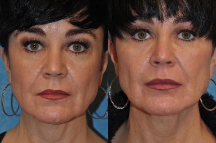 Before & After Injectable Treatments Case 408 Front View in Toledo, Ohio