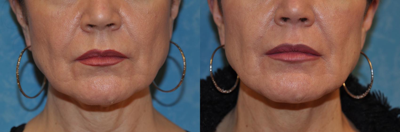 Before & After Injectable Treatments Case 408 Lower face View in Toledo, Ohio