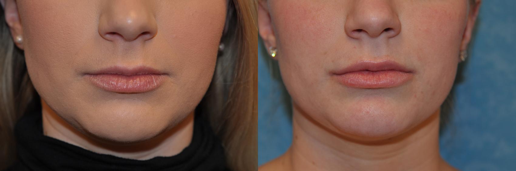 Before & After Injectable Treatments Case 409 Front View in Toledo, Ohio