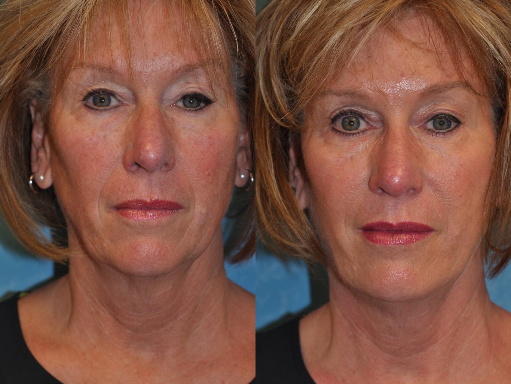 Before & After Injectable Treatments Case 410 Front View in Toledo, Ohio