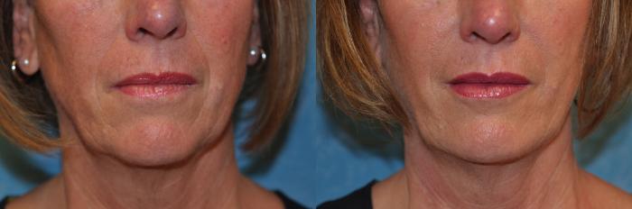 Before & After Injectable Treatments Case 410 Lower face View in Toledo, Ohio