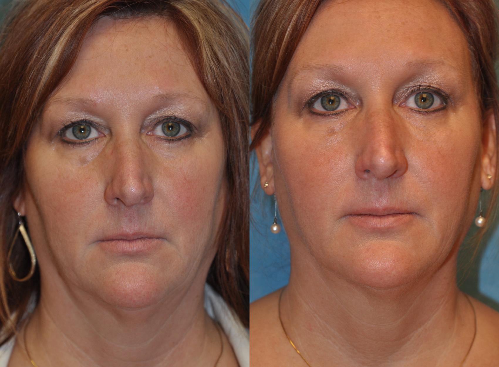 Before & After Injectable Treatments Case 411 Front View in Toledo, Ohio