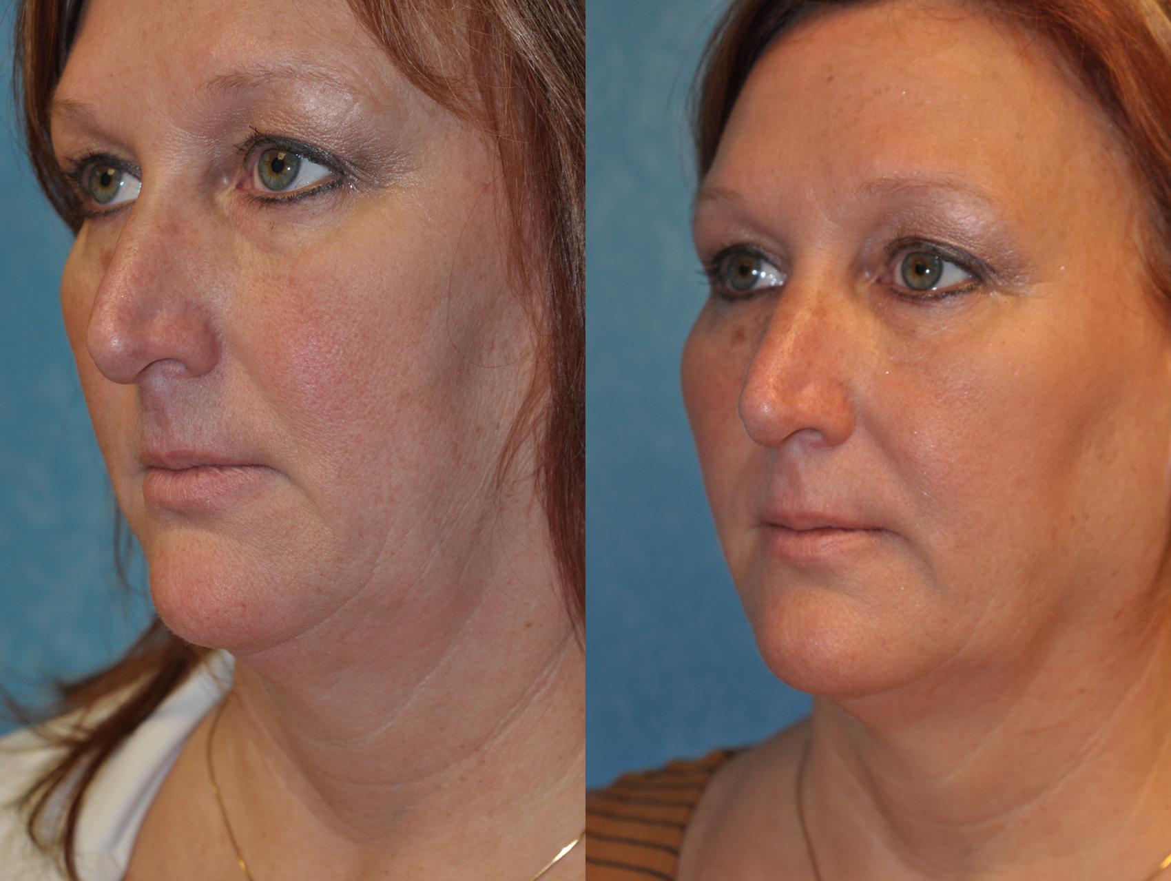 Before & After Injectable Treatments Case 411 Left Oblique View in Toledo, Ohio