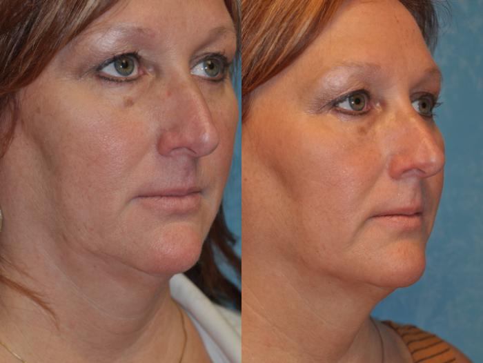 Before & After Injectable Treatments Case 411 Right Oblique View in Toledo, Ohio