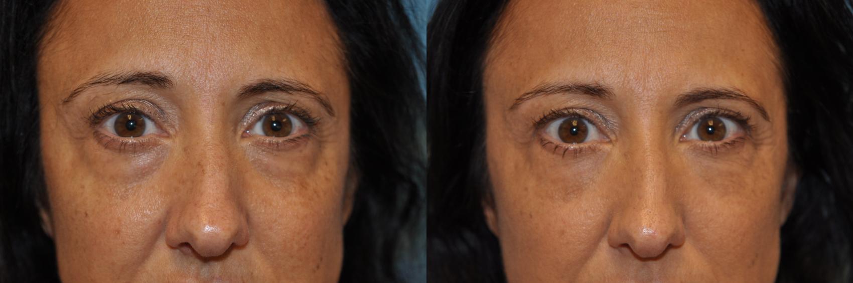 Before & After Injectable Treatments Case 412 Front View in Toledo, Ohio