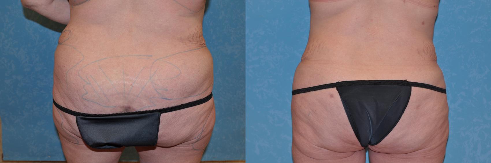 Before & After Liposuction Case 181 View #1 View in Toledo, Ohio