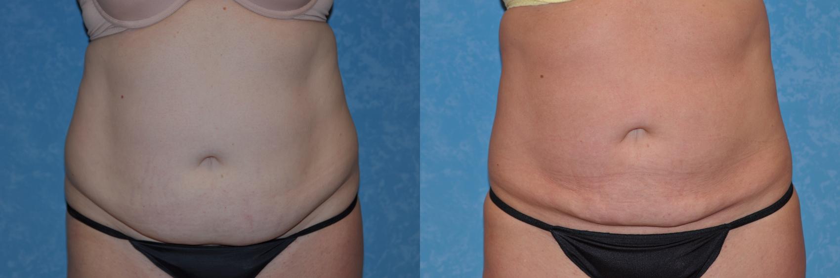 Before & After Liposuction Case 183 View #1 View in Toledo, Ohio
