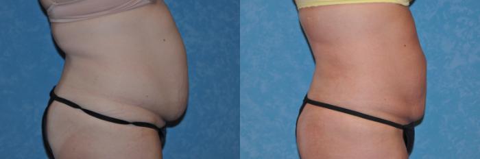 Before & After Liposuction Case 183 View #2 View in Toledo, Ohio