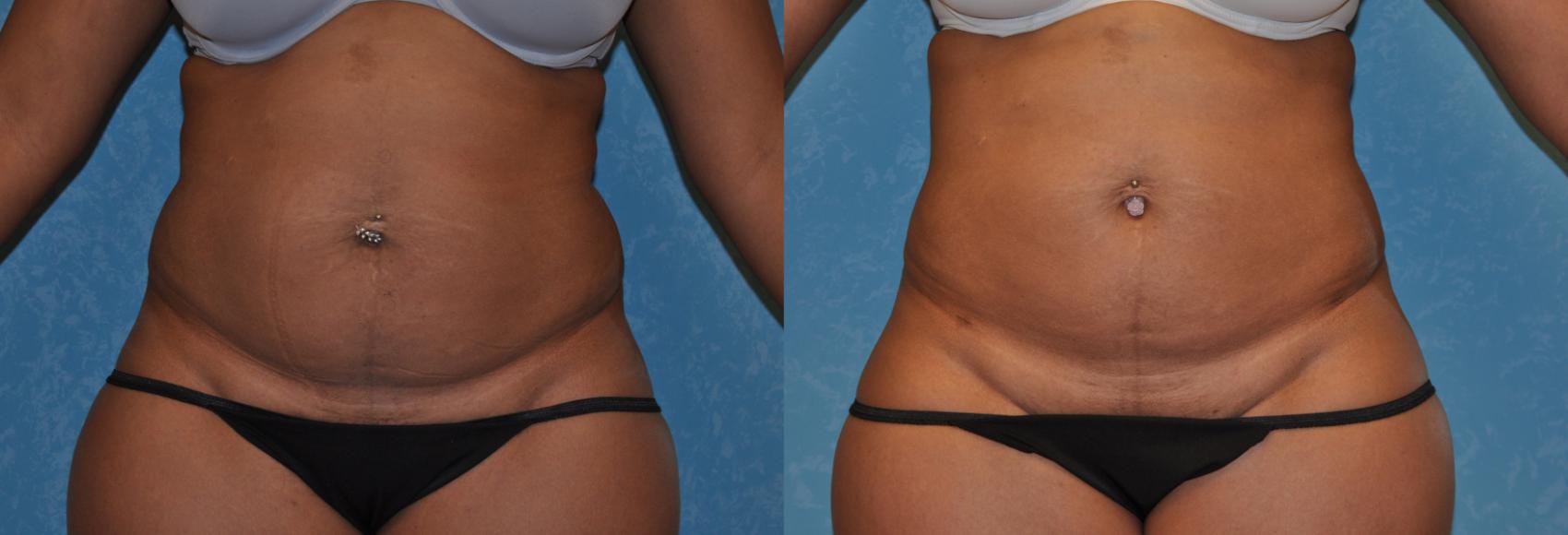Before & After Liposuction Case 351 View #1 View in Toledo, Ohio