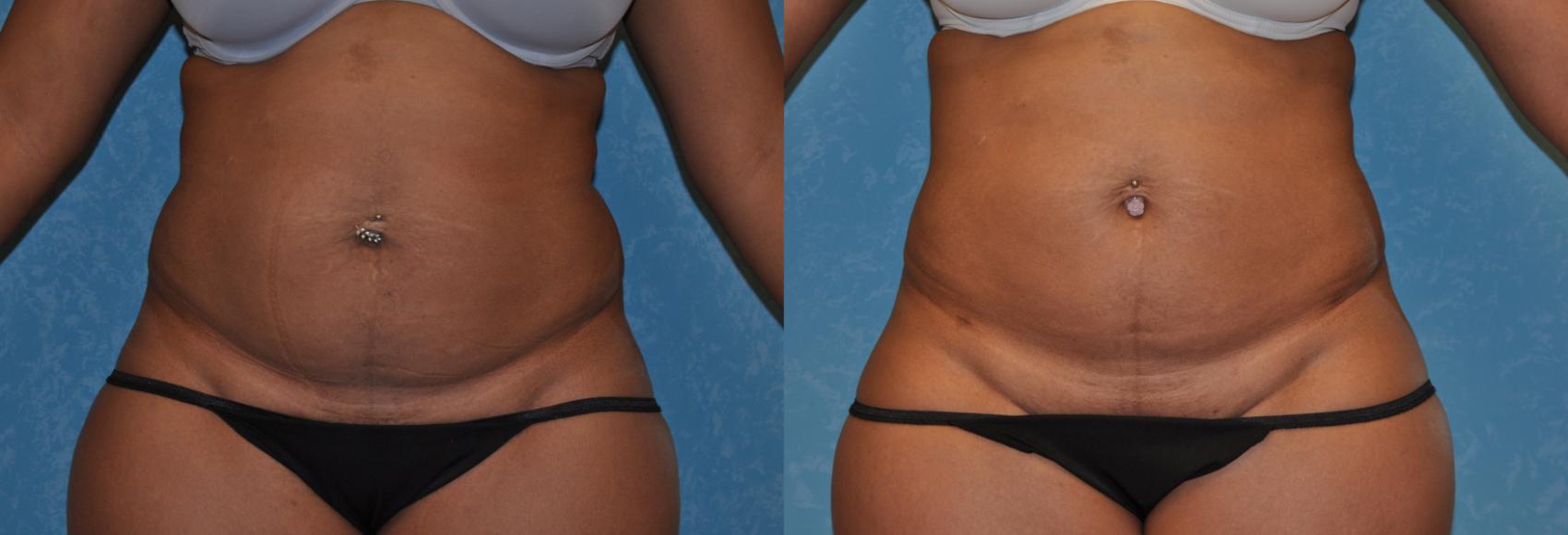 Before & After Liposuction Case 351 View #1 View in Toledo, Ohio