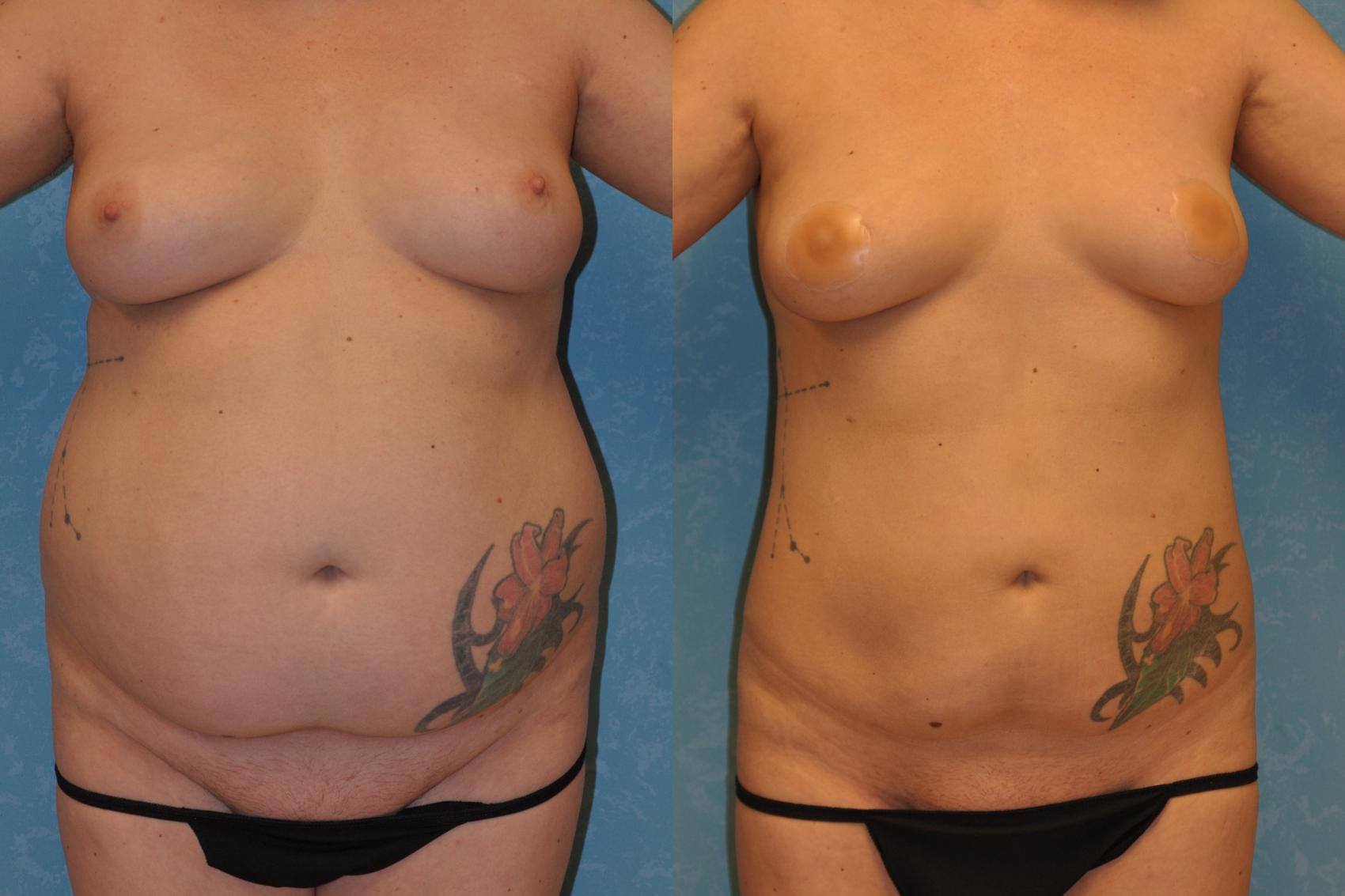 Before & After Liposuction Case 422 Front View in Toledo, Ohio