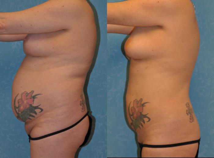 Before & After Liposuction Case 422 Left Side View in Toledo, Ohio