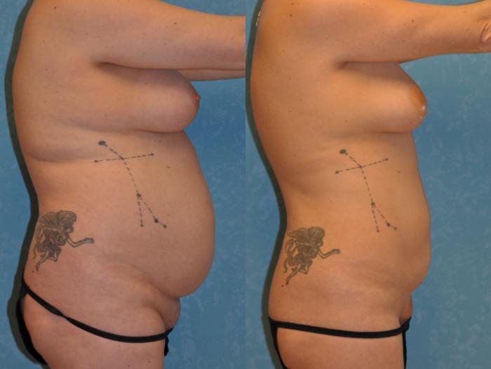 Before & After Liposuction Case 422 Right Side View in Toledo, Ohio