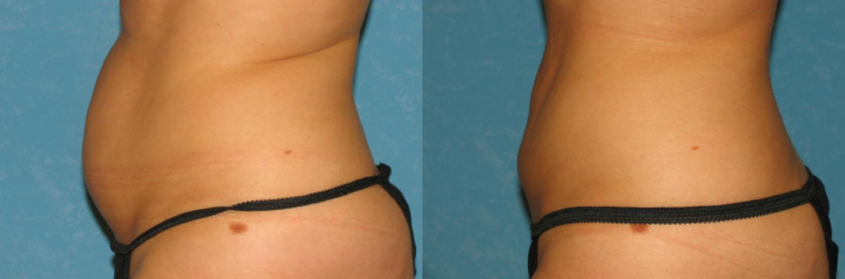 Before & After Liposuction Case 81 View #1 View in Toledo, Ohio