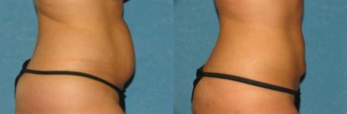 Before & After Liposuction Case 81 View #2 View in Toledo, Ohio