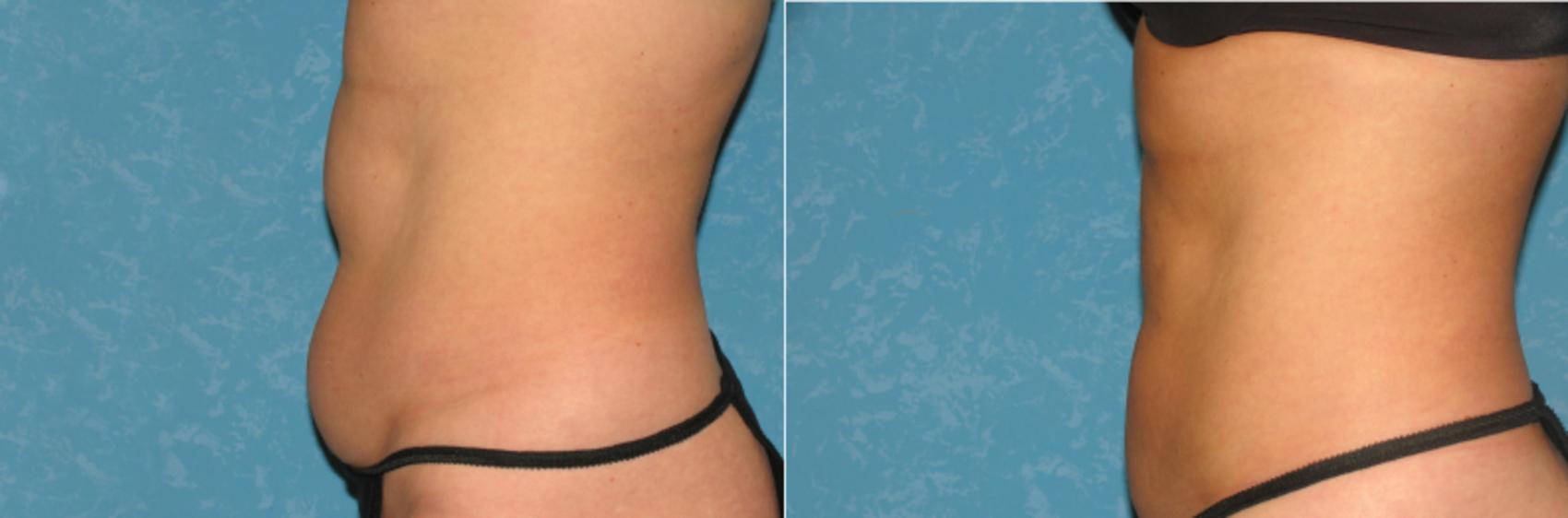 Before & After Liposuction Case 83 View #1 View in Toledo, Ohio