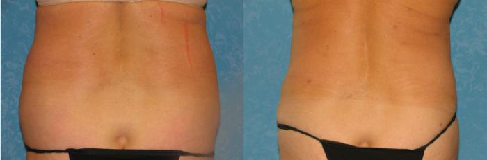 Before & After Liposuction Case 84 View #1 View in Toledo, Ohio