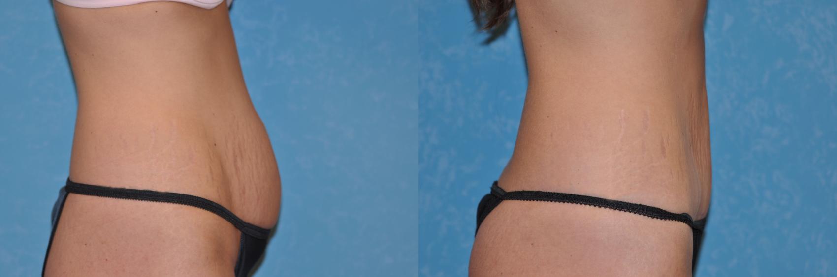 Breast Reduction Before and After Pictures Case 534