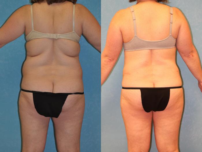 Before & After Liposuction Case 450 Back View in Toledo, Ohio