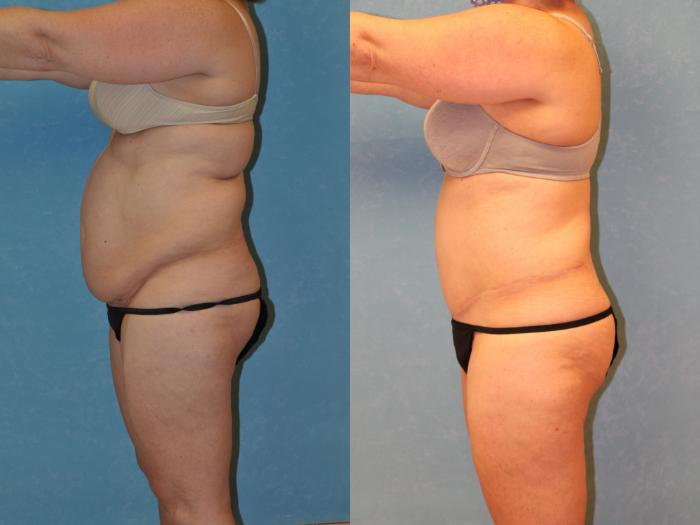 Before & After Liposuction Case 450 Left Side View in Toledo, Ohio