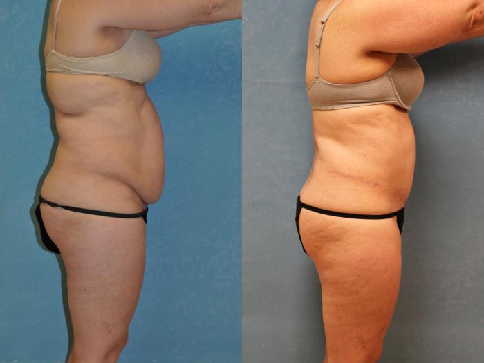 Before & After Liposuction Case 450 Right Side View in Toledo, Ohio