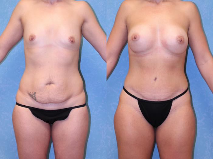 Before & After Abdominoplasty Case 461 Front View in Toledo, Ohio