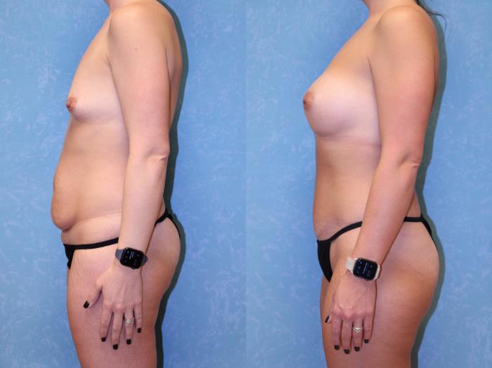 Before & After Breast Augmentation Case 461 Left Side View in Toledo, Ohio