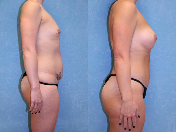 Before & After Breast Augmentation Case 461 Right Side View in Toledo, Ohio