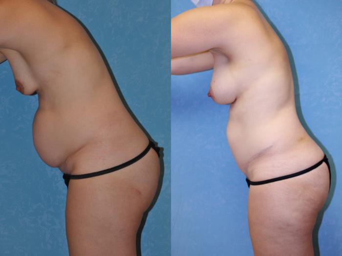 Before & After Mommy Makeover Case 467 Left Side Bent Forward View in Toledo, Ohio
