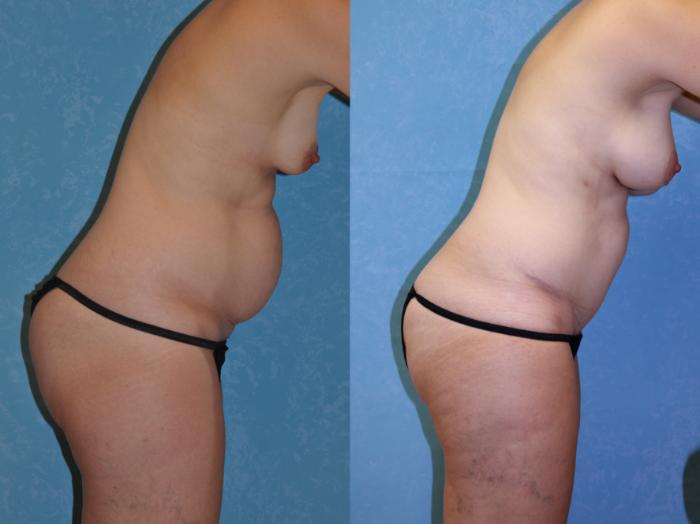 Before & After Mommy Makeover Case 467 Right Side Bent Forward View in Toledo, Ohio