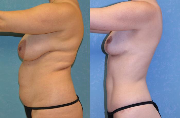 Before & After Abdominoplasty Case 477 Left Side View in Toledo, Ohio