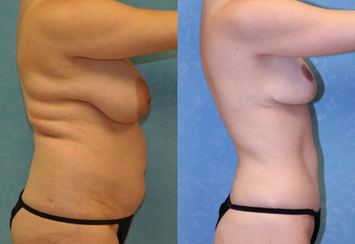 Before & After Liposuction Case 477 Right Side View in Toledo, Ohio