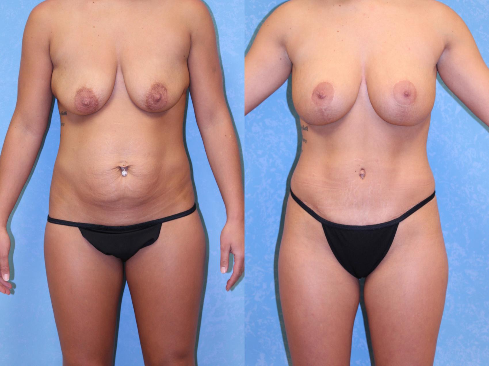 Before & After Liposuction Case 528 Front View in Toledo, Ohio
