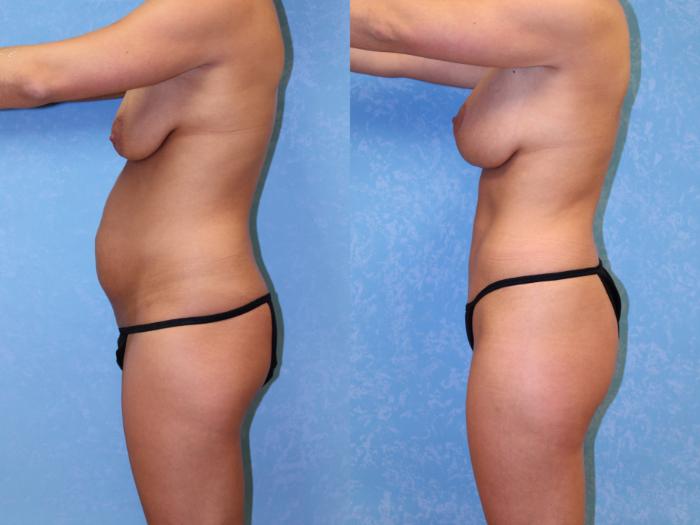 Before & After Liposuction Case 528 Left Side View in Toledo, Ohio