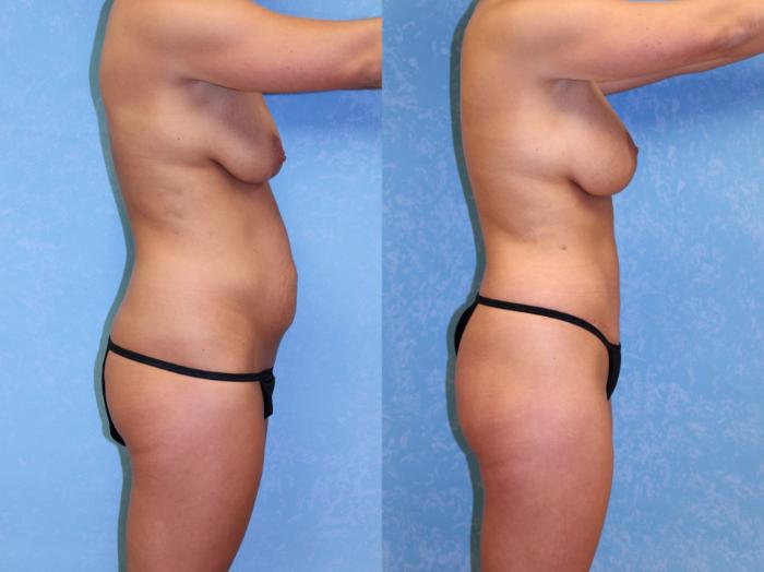 Before & After Liposuction Case 528 Right Side View in Toledo, Ohio