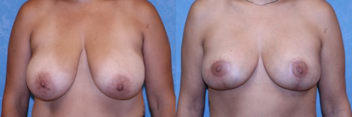 Before & After Body Lift Case 552 Front  View in Toledo, Ohio