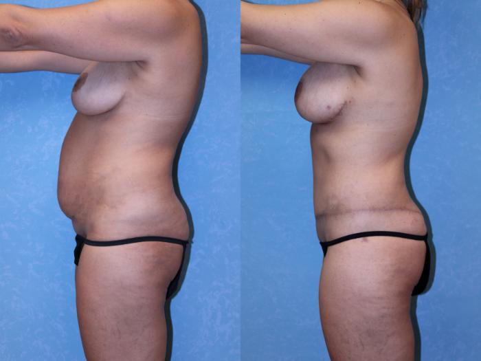 Before & After Body Lift Case 552 Left Side View in Toledo, Ohio