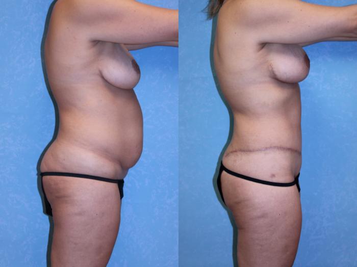 Before & After Body Lift Case 552 Right Side View in Toledo, Ohio
